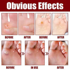 Feet Corn Removal Serum (30ml)