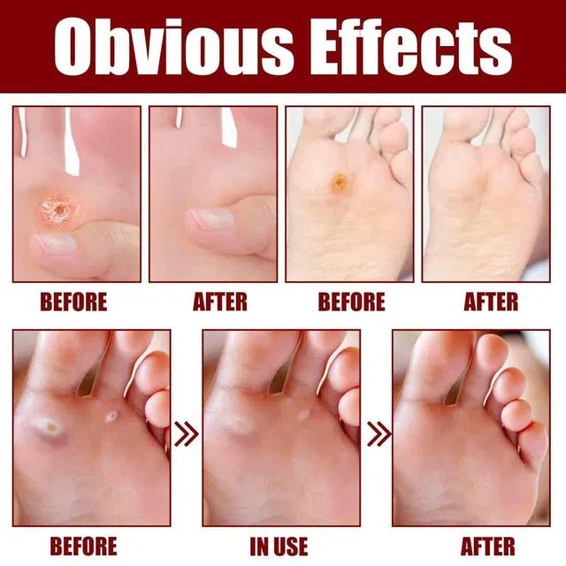 Feet Corn Removal Serum (30ml)